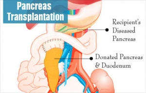 Best Pancreatic Surgeon in Singapore – Trusted Care for Pancreatic Conditions