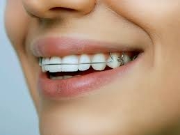 Can Dental Appliances Help With Sleep Apnea?