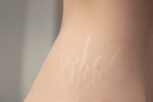 What are Stretch Marks? What Causes Them?