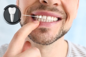 Dental Implants vs. Veneers: Which One Solves Missing Teeth?