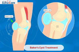 Baker’s Cyst Treatment in India with Edhacare