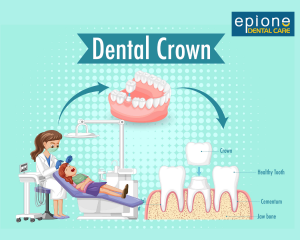 How Long Do Dental Crowns Last? Expert Tips on Care and Maintenance