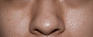 How Can I Prevent My Face from Having Open Pores?
