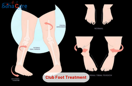 Club Foot Treatment in India – Causes, Symptoms & Orthopedic Care