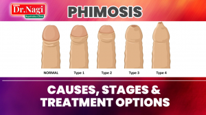 Phimosis: Complete Guide to Symptoms, Causes, and Treatment Options
