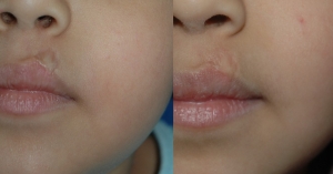 Lip Scar Treatment: Effective Options for a Smooth Recovery and Lasting Results.
