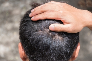 How Effective Is Stem Cell Therapy for Hair Loss Now?
