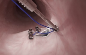 Endoscopic Closure Systems Market Size, Share and Research 2025-2033