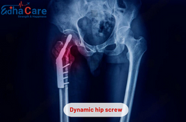Dynamic Hip Screw Treatment in India with Edhacare