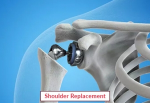 Shoulder Replacement Surgery Treatment in India