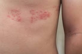 Exploring the Sensory Symptoms of Shingles: Pain, Tingling, and More