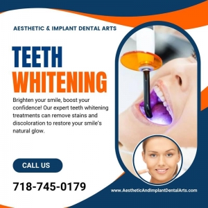 Are There Any Side Effects of Teeth Whitening? A Homeowner’s Guide