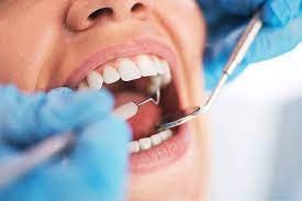 Can Composite Fillings Break or Fall Out?