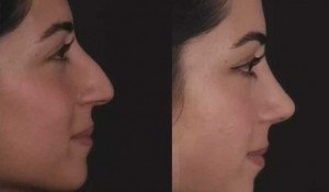 Best Septoplasty Surgeon in Dubai: Where Health Meets Aesthetics