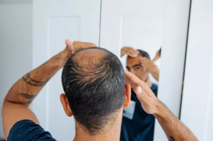 How to Prepare for a Hair Transplant Surgery