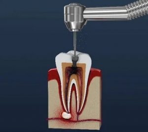 Root Canal Treatment in Islamabad: Cost, Procedure, and Recovery