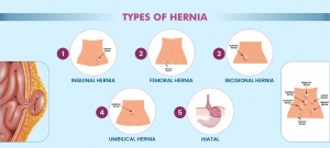 Understanding the Different Types of Hernia and Treatment Options in Pune