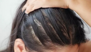 What Are Common Myths About Scalp Micropigmentation?