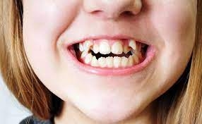 Are Braces the Only Option for Crowded Teeth?