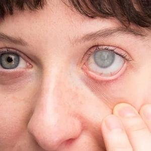 What to Expect from Glaucoma Treatment