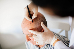 The Science Behind Hair Transplant in Riyadh Procedures