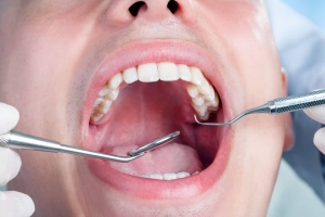 How Much Does Full Mouth Rehabilitation Cost?