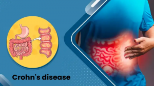 Crohn’s Disease: Myths vs Facts About a Cure