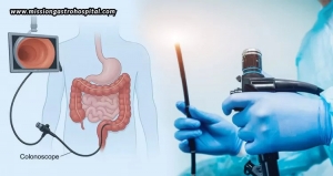 Colonoscopy: Age-Appropriate Screening Guidelines