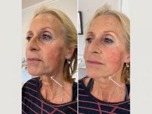 Benefits of Endolift According to the Best Plastic Surgeons in Dubai