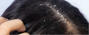 Scalp Hygiene Tips to Prevent Dandruff