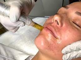Can Men Benefit From Dermapen Treatment?