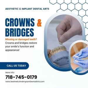 What Are Metal-Free Crowns and Bridges? A Complete Guide