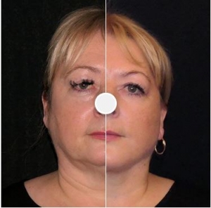 Unlocking the Power of Vaser Liposuction: Your Path to Sculpted Confidence