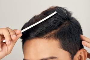 Does Hair Transplant Deliver Thicker Density
