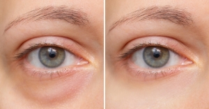 Blepharoplasty Before and After: Complete Guide to Eyelid Surgery