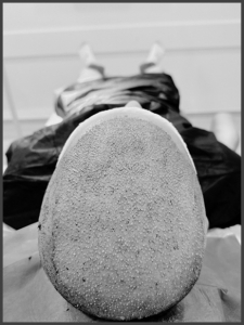 Which Treatments Work Best for Each Norwood Stage of Baldness?