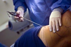 Personalized Liposuction in Islamabad Plans
