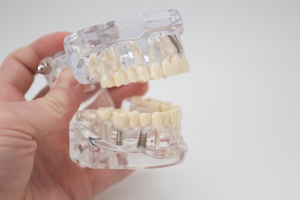 How to Clean All-on-4 Dental Implants: A Complete Guide
