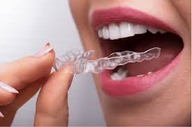 How Clear Braces Work: A Simple Guide for First-Time Users