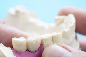 Smile Restoration with Dental Crowns in Camarillo