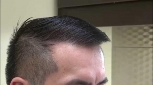 Preparing for Your Hair Transplant in Islamabad