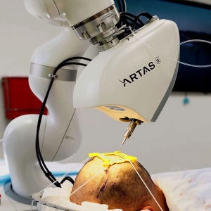 How Robotic Hair Transplant Reduces Human Error?