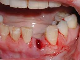 Does Tooth Extraction Hurt After the Procedure?