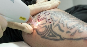 How to Speed Up Your Tattoo Removal Process Safely: Expert Advice on Laser Tattoo Removal in Riyadh