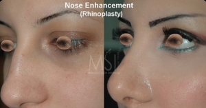 Rhinoplasty Pics Before and After: Incredible Positive Outcomes