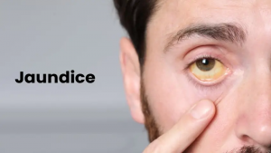 Long-Term Complications of Untreated Jaundice