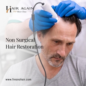 Non Surgical Hair Replacement for Men in Fresno
