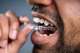 Clear Retainers: Everything You Need to Know