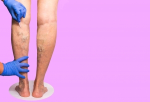 How Do I Choose the Best Vein Treatment Clinic Near Me?