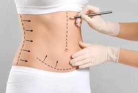 What Is the Recovery Diet After Liposuction Surgery?